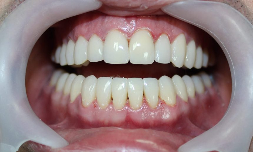 Restaurări dentare directe – Crează-ți un zâmbet atractiv!