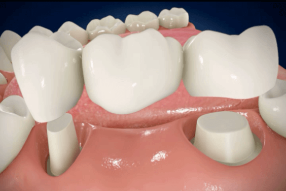 Зубное протезирование (ортопедия)
